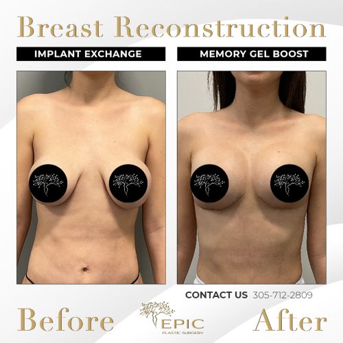 Breast reconstruction: before and after comparison.